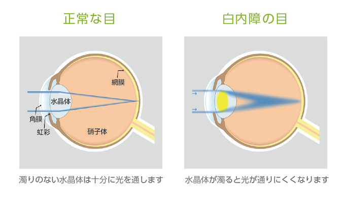 白内障 眼科 中国語医療通訳